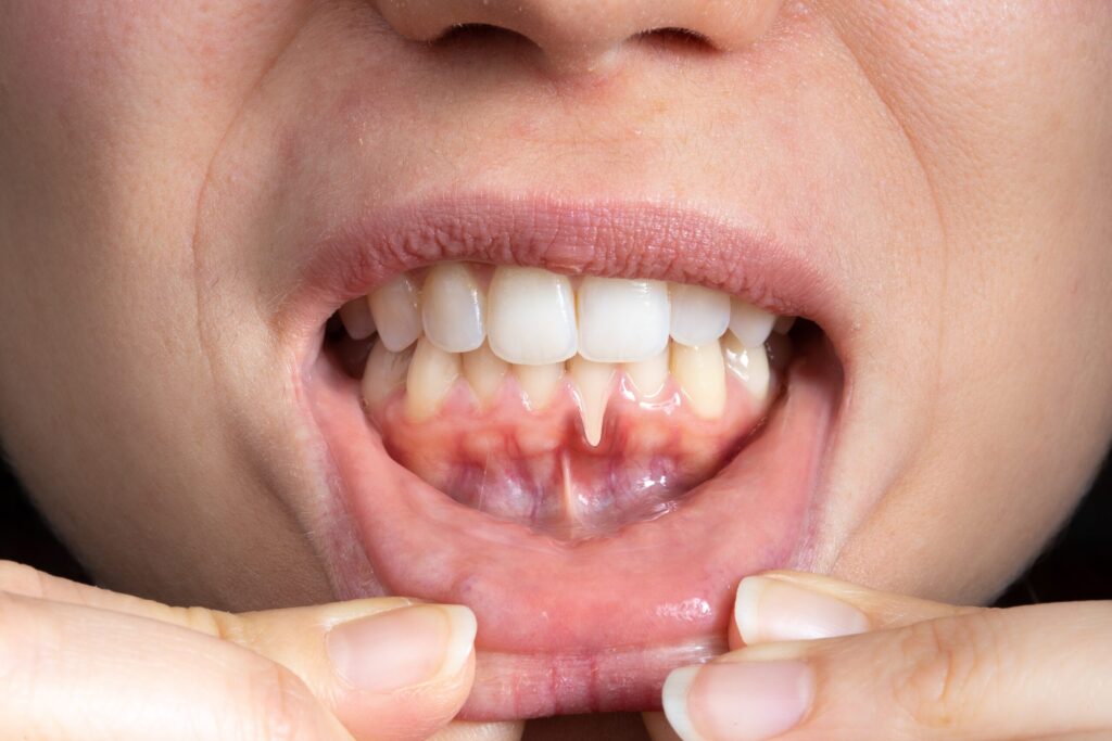 Preparing for teeth whitening with receding gums Doncaster